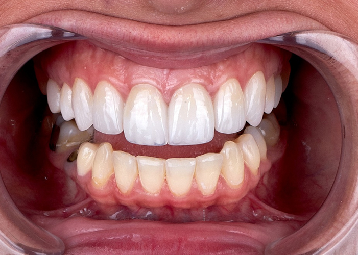 무삭제 라미네이트